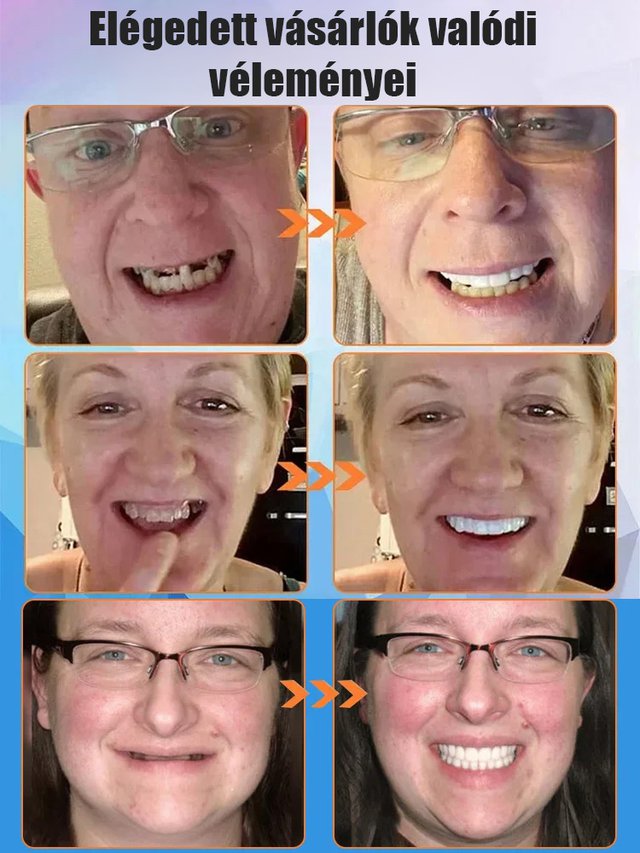 [Új brit kutatási eredmények] Szilikon szimulációs fogszabályozó fogszabályozó