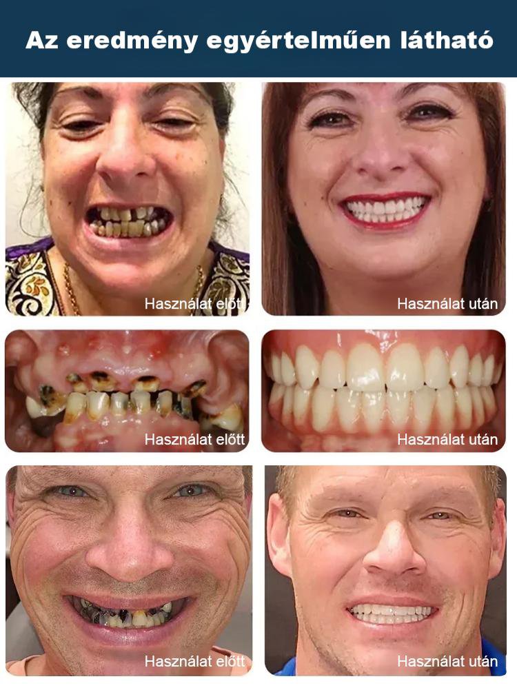 【Fogközt kitöltő】 hidroxiapatit fogkrém