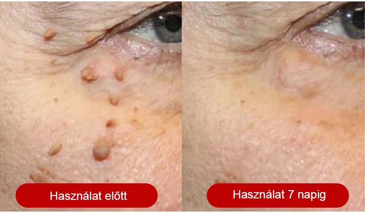 【Egy másodperces szemölcseltávolító】Szemölcseltávolító krém