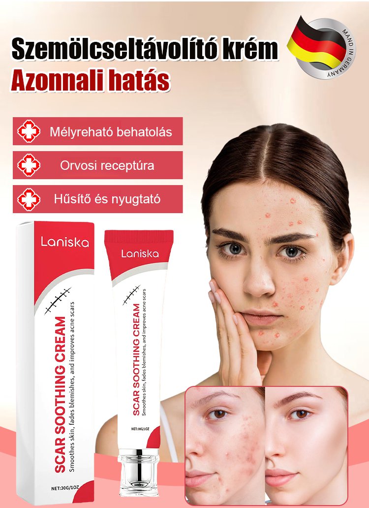 【Egy másodperces szemölcseltávolító】Szemölcseltávolító krém